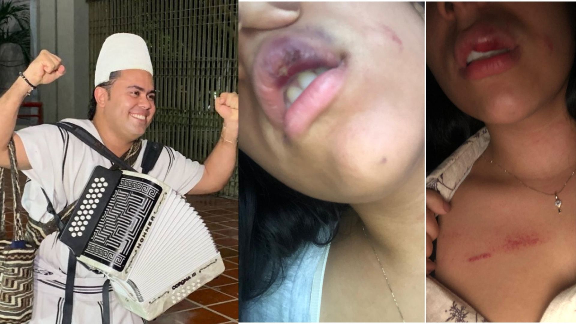 Brutal golpiza a su exnovia, el hecho que empaña la victoria del nuevo Rey Vallenato José Villafañe