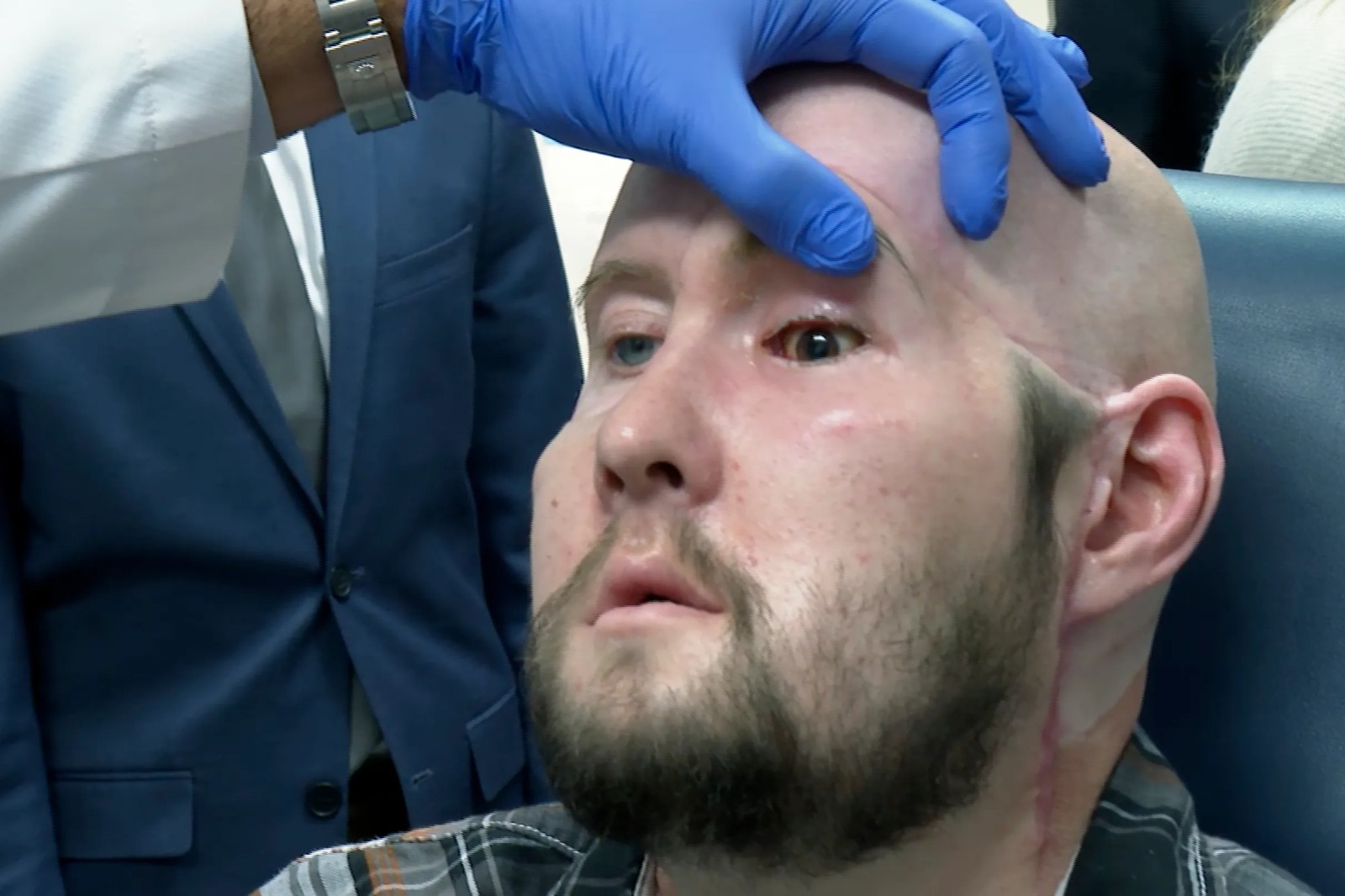 ¡Impresionante! Realizan el primer trasplante de ojo completo en el mundo